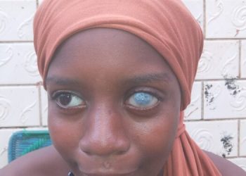 SOS : Aissatou, 11 ans, risque de perdre la vue — un appel urgent à la solidarité
